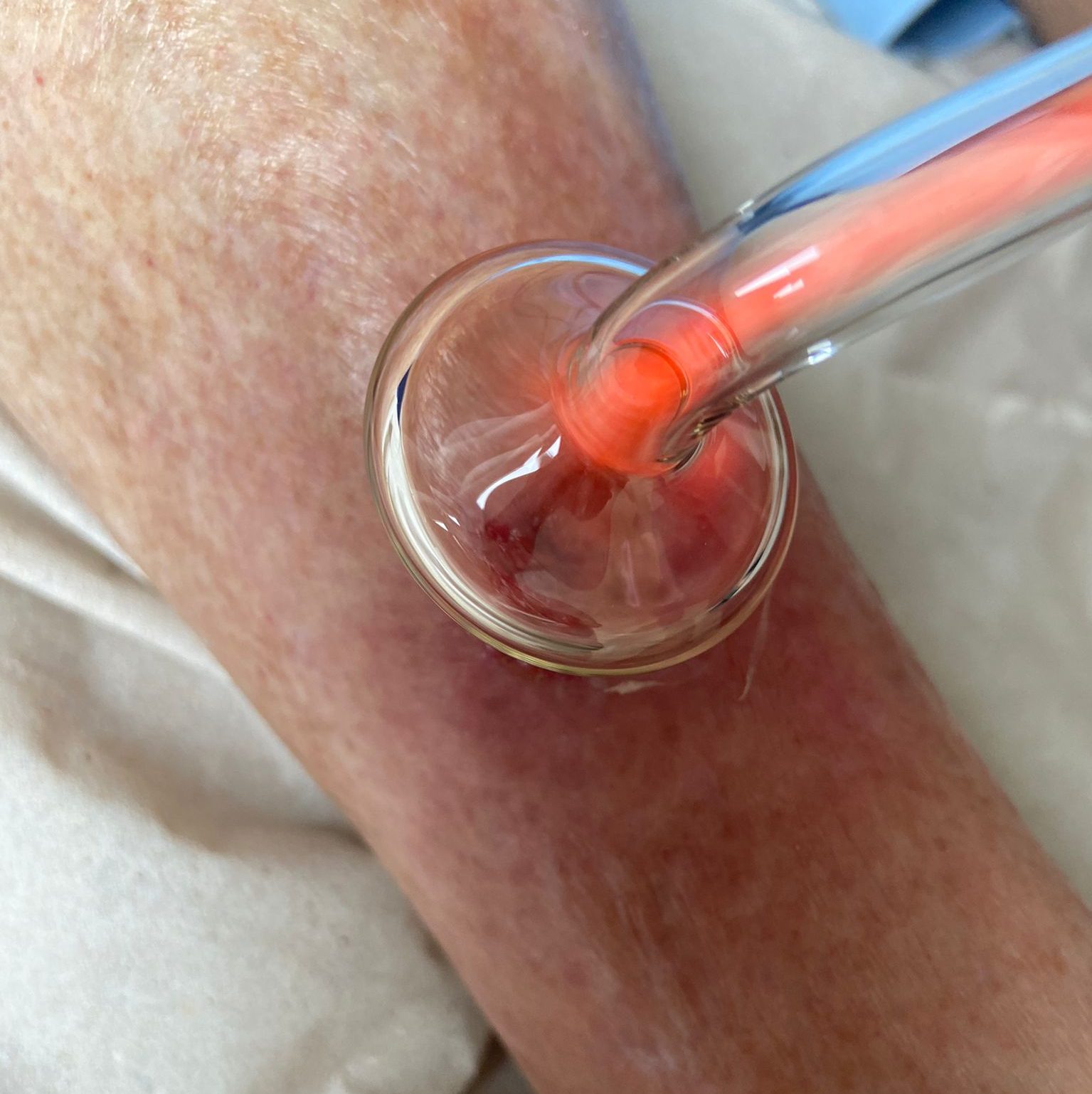 Kaltes Plasma kann bei einer Vielzahl von Haut- und Wundproblemen eingesetzt werden,